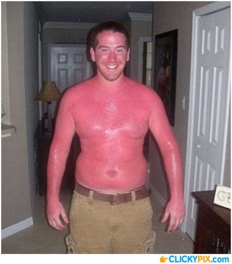 10 Bad Sunburns Ideas Bad Sunburn Sunburn Funny Sunburn