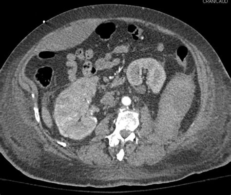 Right Rectus Hematoma And Left Retroperitoneal Hematoma In A Renal