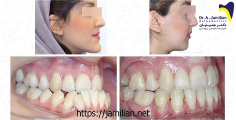 Maxillary Retrusion - Dr jamilian