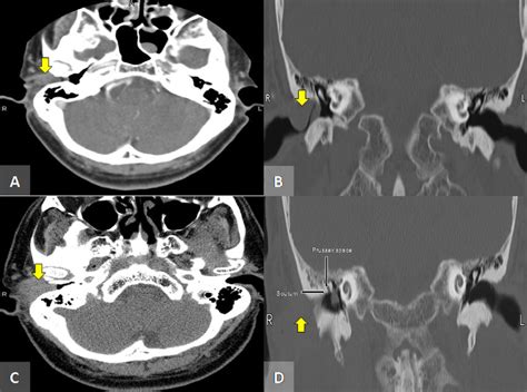 Internal Acoustic Meatus Temporal Bone 