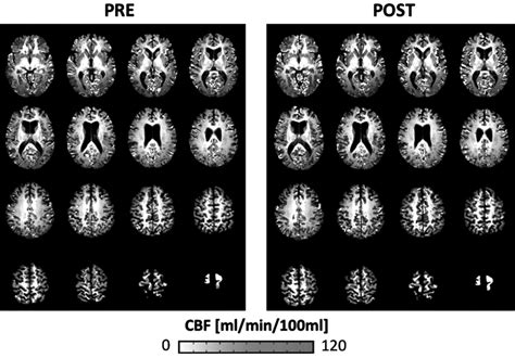 Neuropsychological And Neuroimaging Correlates Of High Altitude Hypoxia Trekking During The