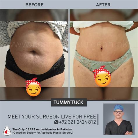 Tummy Tuck Before & After Results - Cosmetic Surgeon