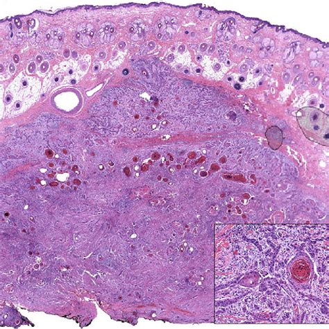 Moderately Differentiated Squamous Cell Carcinoma Hematoxylin Eosin Download Scientific