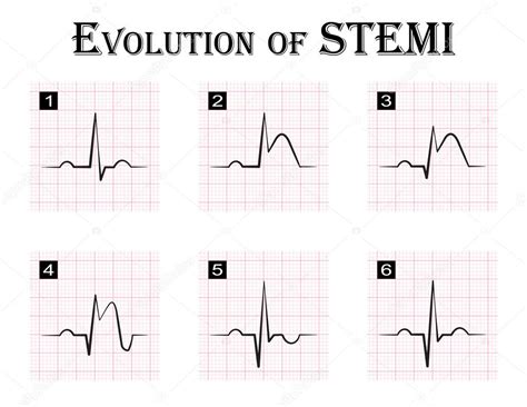 Ecg De La Evolución Paso A Paso De Stemi Elevación Del Segmento St Infarto De Miocardio