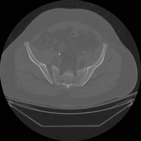 Presenting Ap Pelvis Radiograph Demonstrating The Open Book Pelvic Download Scientific Diagram