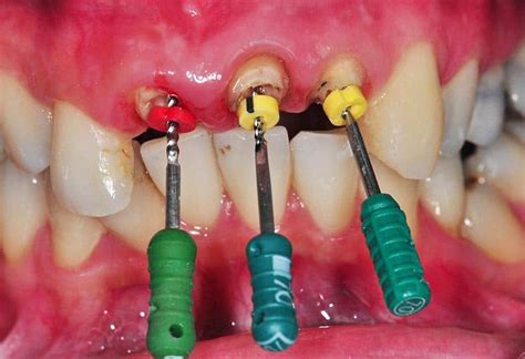 Root Canal on Front Tooth: Procedure and Cost | Thompson Creek Dental