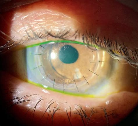 Corneal Transplant Optometry