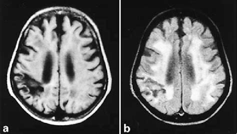 Figure 1 From Apraxia Of Eyelid Closure Complicating Right Parietal Infarction Semantic Scholar