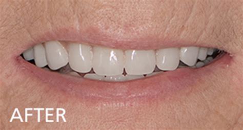 Smile Gallery Verroche Denture Clinic St Catharines Ontario