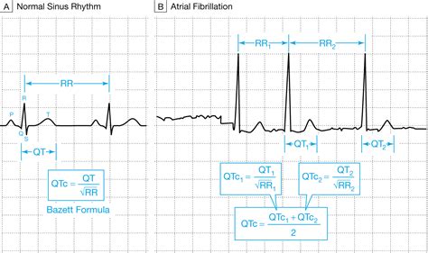 What Clinicians Should Know About the QT Interval | JAMA | JAMA Network