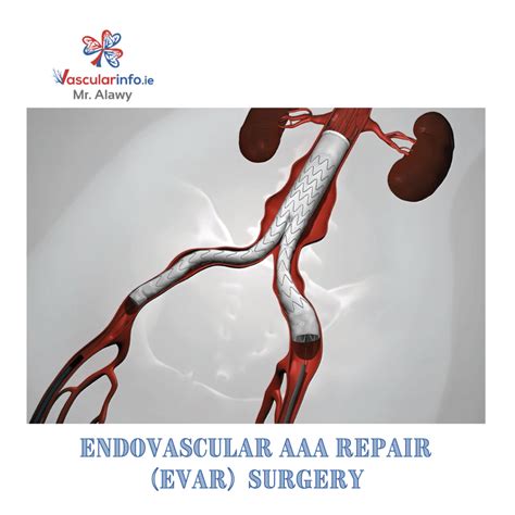 Thoracic Aortic Aneurysm Vascular Info