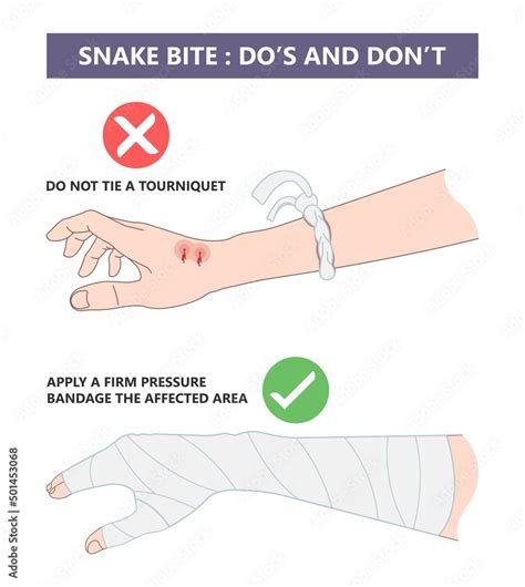 Snake Bite First Aid Poster