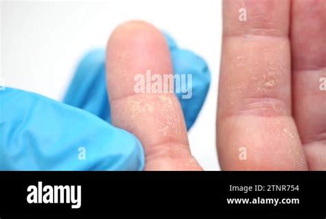 Dry Hands Peeling Of Skin On Hands And Fingers Chemical Allergy