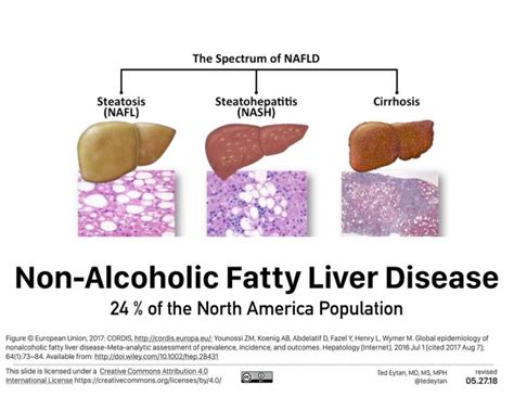 Non Alcoholic Fatty Liver Disease Nafld A Silent And Serious