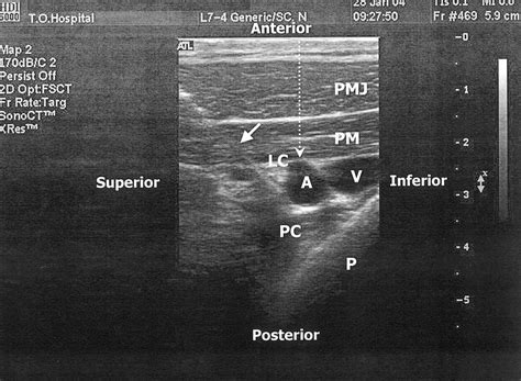 Infraclavicular Block