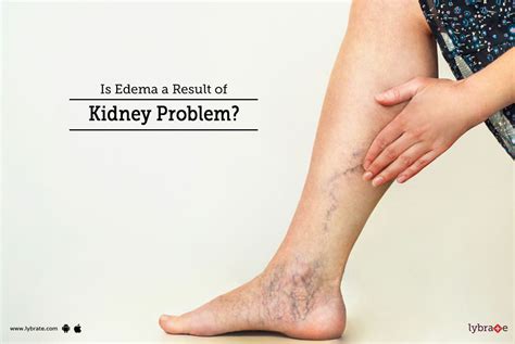 Is Edema A Result Of Kidney Problem By Dr Garima Lybrate