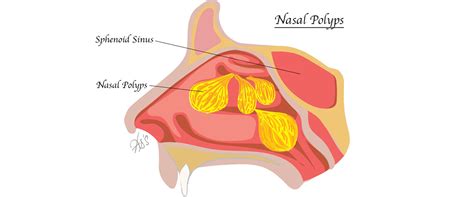 Swollen Nasal Polyps Dislodged Nasal Polyps Causes Symptoms And