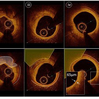 Calcium Modification Guided By Oct Panel Ademonstrates A Severe