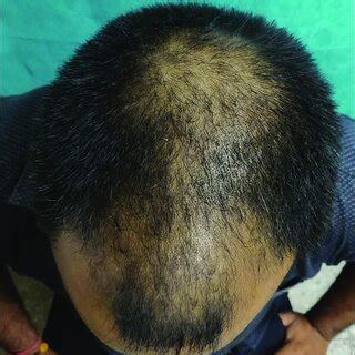 Clinical Image Of Androgenetic Alopecia Norwood Hamilton Scale V