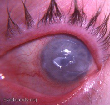 Fuchs' epithelial-endothelial dystrophy of the cornea OD. EyeRounds.org: Online Ophthalmic Atlas