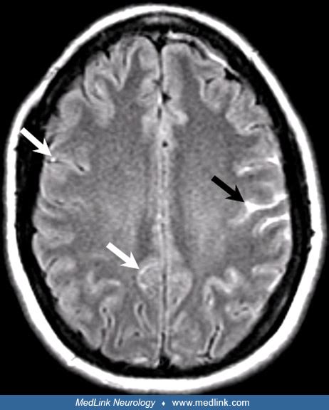 Reversible Cerebral Vasoconstriction Syndromes Medlink Neurology