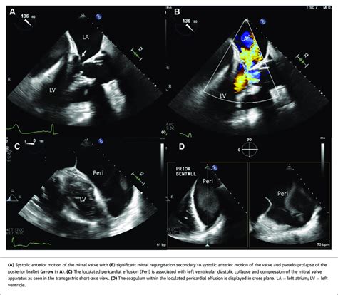 Intraoperative Transesophageal Echocardiogram | Download Scientific Diagram