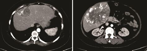 Contrast Enhanced Computed Tomography Scan Of The Liver Images Depict