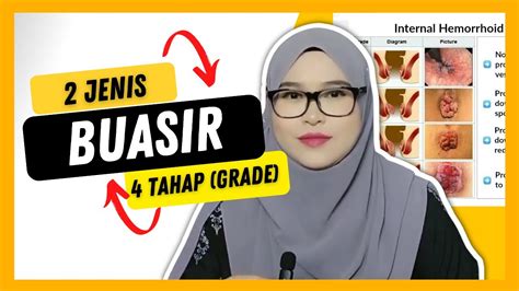 Jenis Buasir Tahap Buasir Dalam Gambar Youtube