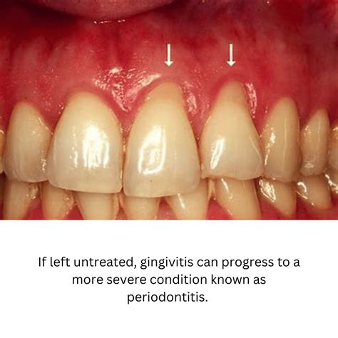 What Does Gingivitis Look Like Recognizing The Signs Of Gum Disease