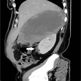 Post Operative Ct Scan Sagittal View One Month The Follow Up Image Is