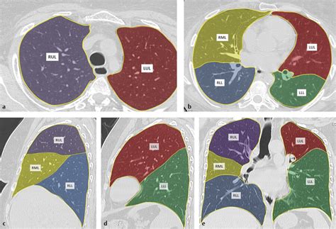 Bronchopulmonary Segment