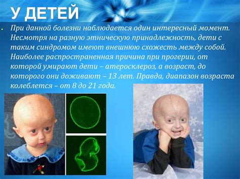 Генетические заболевания. Прогерия. Синдром Юнера Тана - презентация онлайн