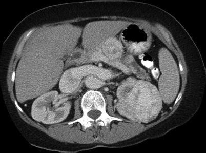 Renal Mass Biopsy | Radiology Key