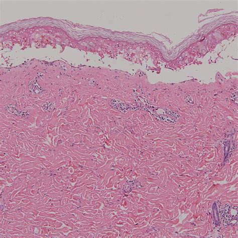 Histopathology He ×100 Showing Subepidermal Blister With Overlying Download Scientific