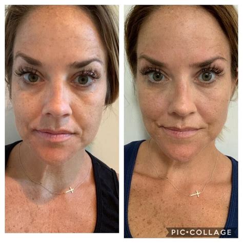 Modere Collagen Before And After Real Results Revealed Must Read