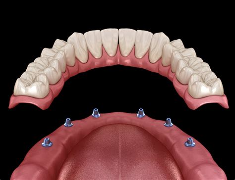 Prothèse dentaire fixe | Dentier, Bridge, Implant, Couronne | Prix et Usage