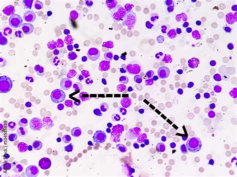 Microscopic Image Of Bone Marrow Plasma Cell Dyscrasia Or Multiple