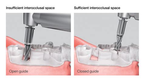 Osstem Implant