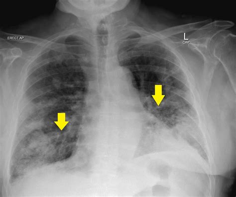 Amyloidosis X Ray Wikidoc