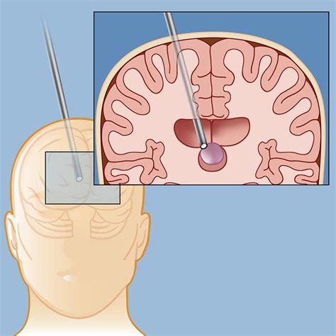 Surgery for a Colloid Cyst | Weill Cornell Brain and Spine Center