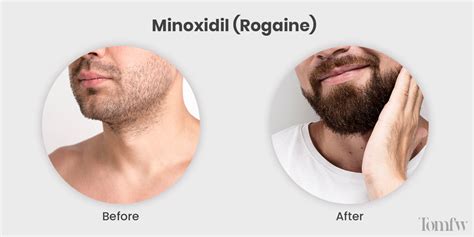 Minoxidil Beard Review Rogaine Before And After Tomfw