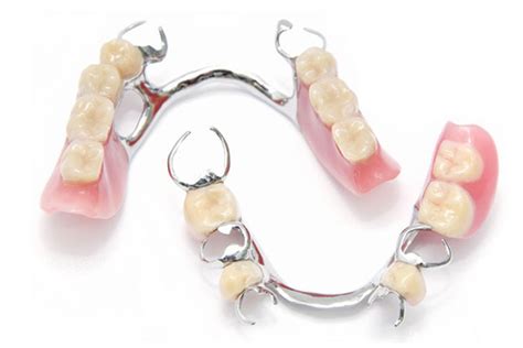 သတ္တု သွားအံကပ်လုပ်ခြင်း ( Metallic Denture ) | The Grand Dental