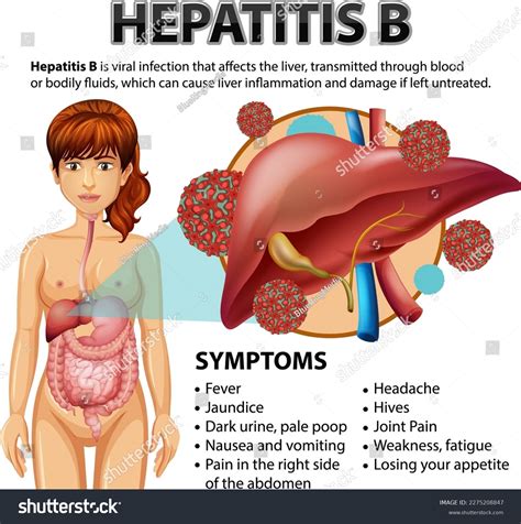 Symptoms Hepatitis B Illustration Stock Vector Royalty Free