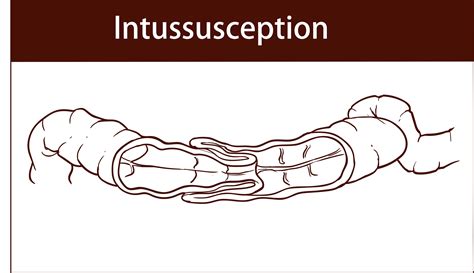 Intussusception 腸套疊 衛教單張 China Medical University Hospital