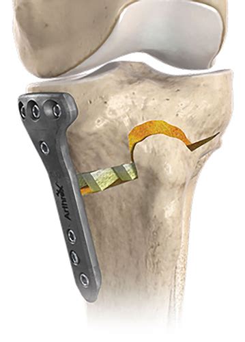 Hto High Tibial Osteotomy Spine And Joint Clinic