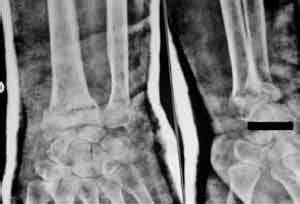 fig 4 fracture getting displaced