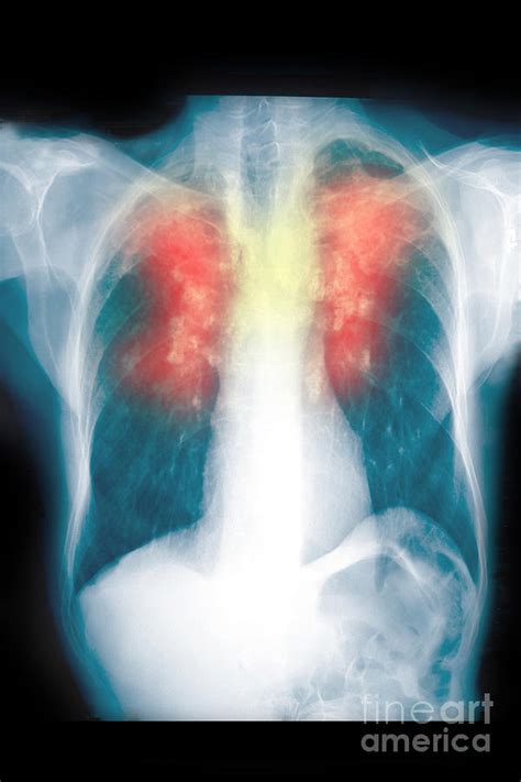 Chest X Ray Showing Silicosis Photograph By Scott Camazine Fine Art