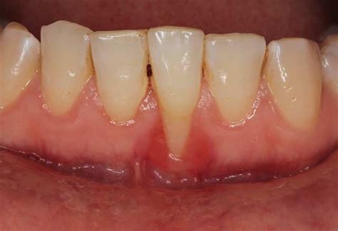 Understanding Muco Gingival Defects And Gingival Recession Your