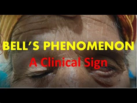 Bell's Phenomenon | LMN Facial Palsy | Clinical Sign | Neurology - YouTube