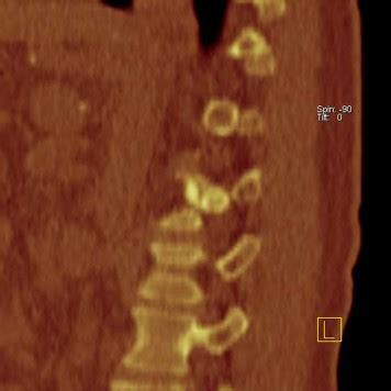 Case Of The Week The Value Of Whole Body Scintigraphy Using M Tc